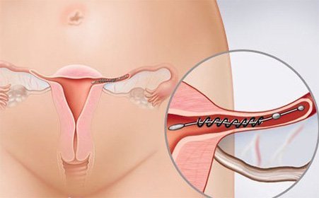 宫外孕的症状表现是什么