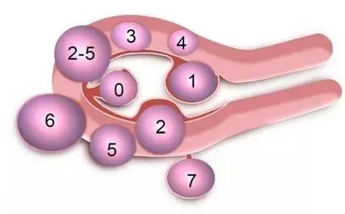 子宫肌瘤的3种类型