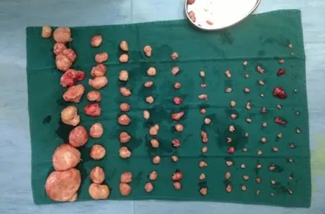 子宫肌瘤需要手术吗